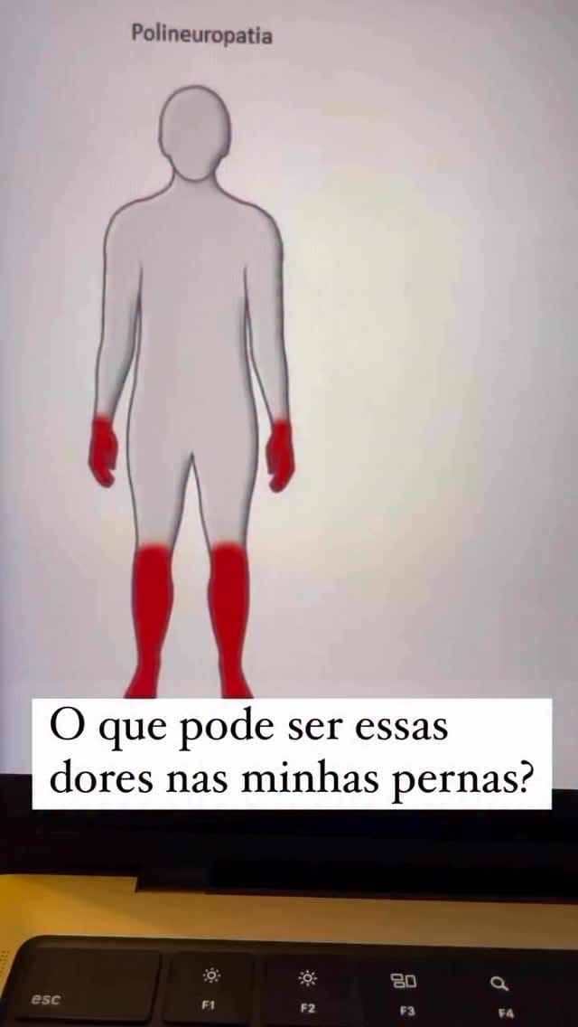 Post 3 by Dr. Vinício Nunes - Goiânia / Hérnia de Disco / Escoliose on Instagram (video)
