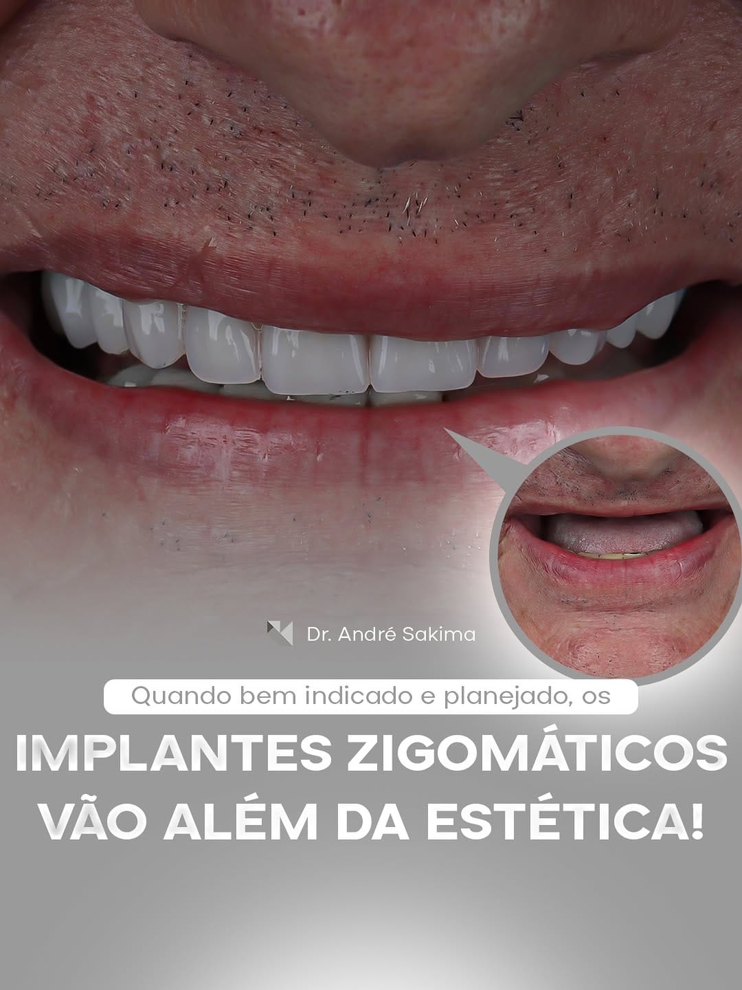 Post 4 by Dr. André Sakima | Ortognática | ATM | Implantes on Instagram (image)