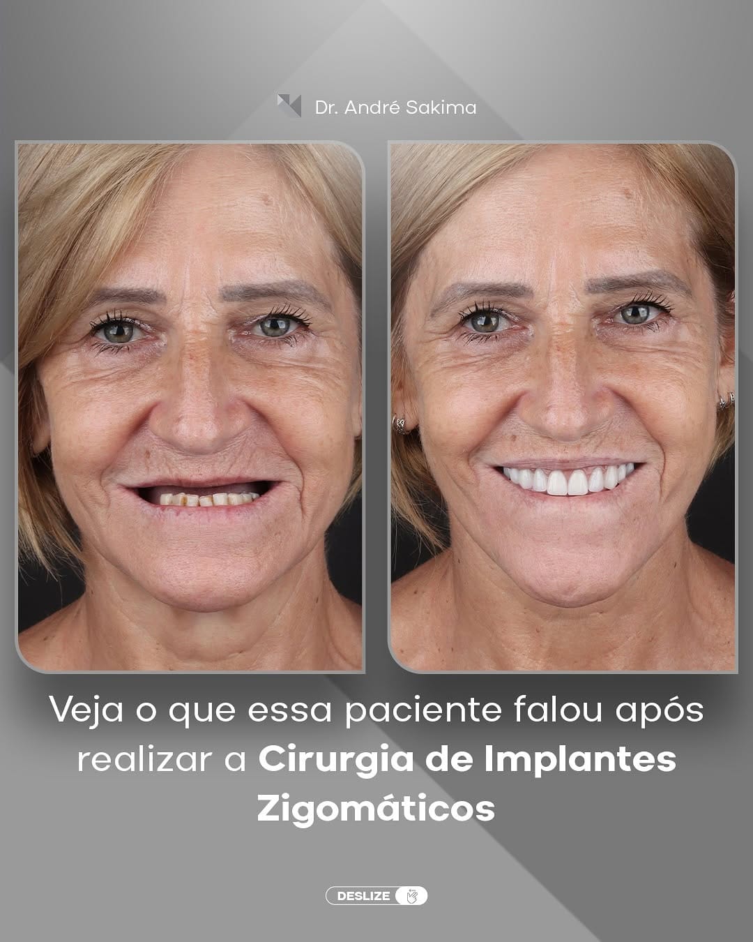 Post 10 by Dr. André Sakima | Ortognática | ATM | Implantes on Instagram (carousel)