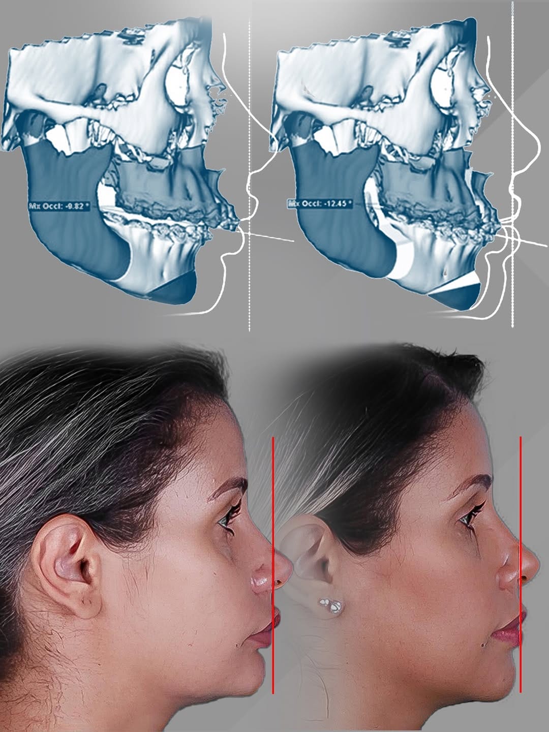 Post 8 by Dr. André Sakima | Ortognática | ATM | Implantes on Instagram (image)