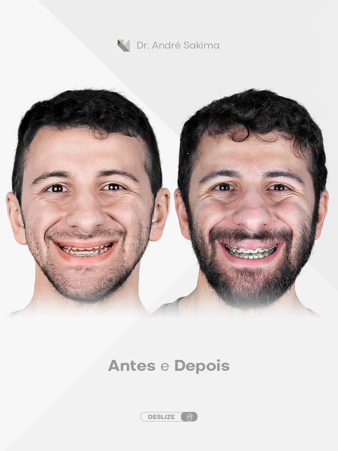 Post 6 by Dr. André Sakima | Ortognática | ATM | Implantes on Instagram (carousel)
