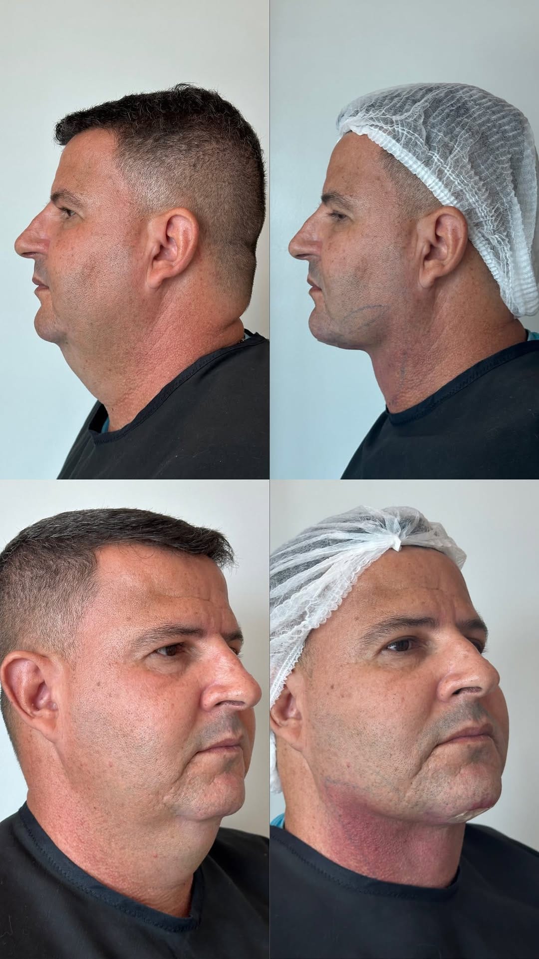 Post 8 by Dra. Daniele Pinheiro | Lipo de Papada Salvador on Instagram (video)