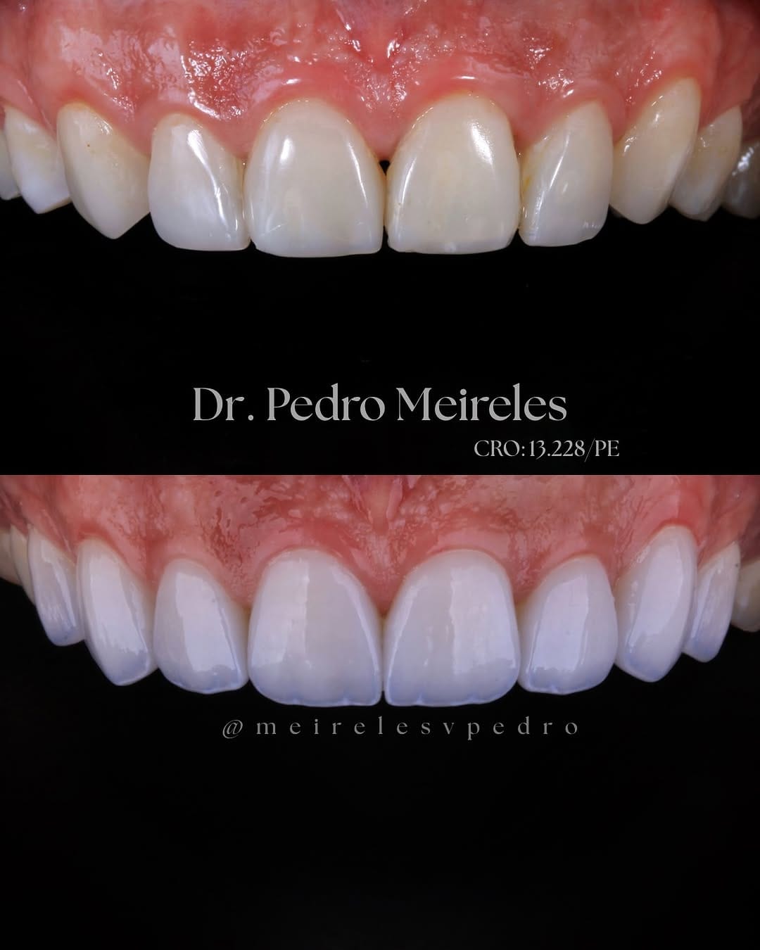 Post 10 by Pedro Meireles || Facetas e Lentes de contato on Instagram (image)