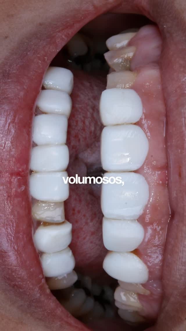 Post 3 by Pedro Meireles || Facetas e Lentes de contato on Instagram (video)