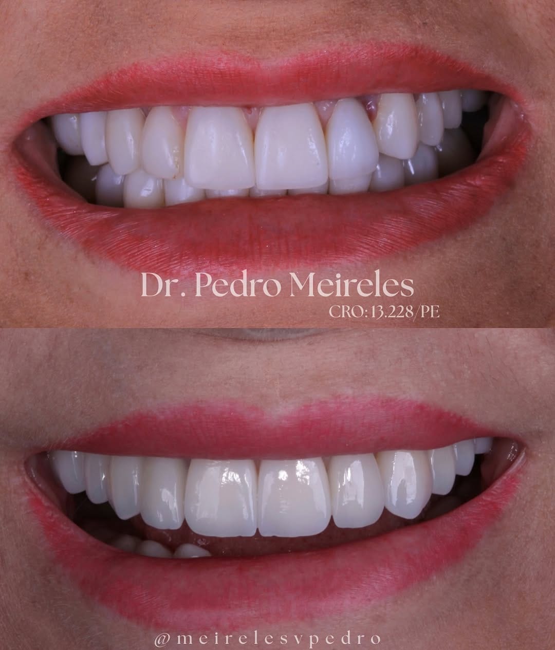 Post 9 by Pedro Meireles || Facetas e Lentes de contato on Instagram (image)