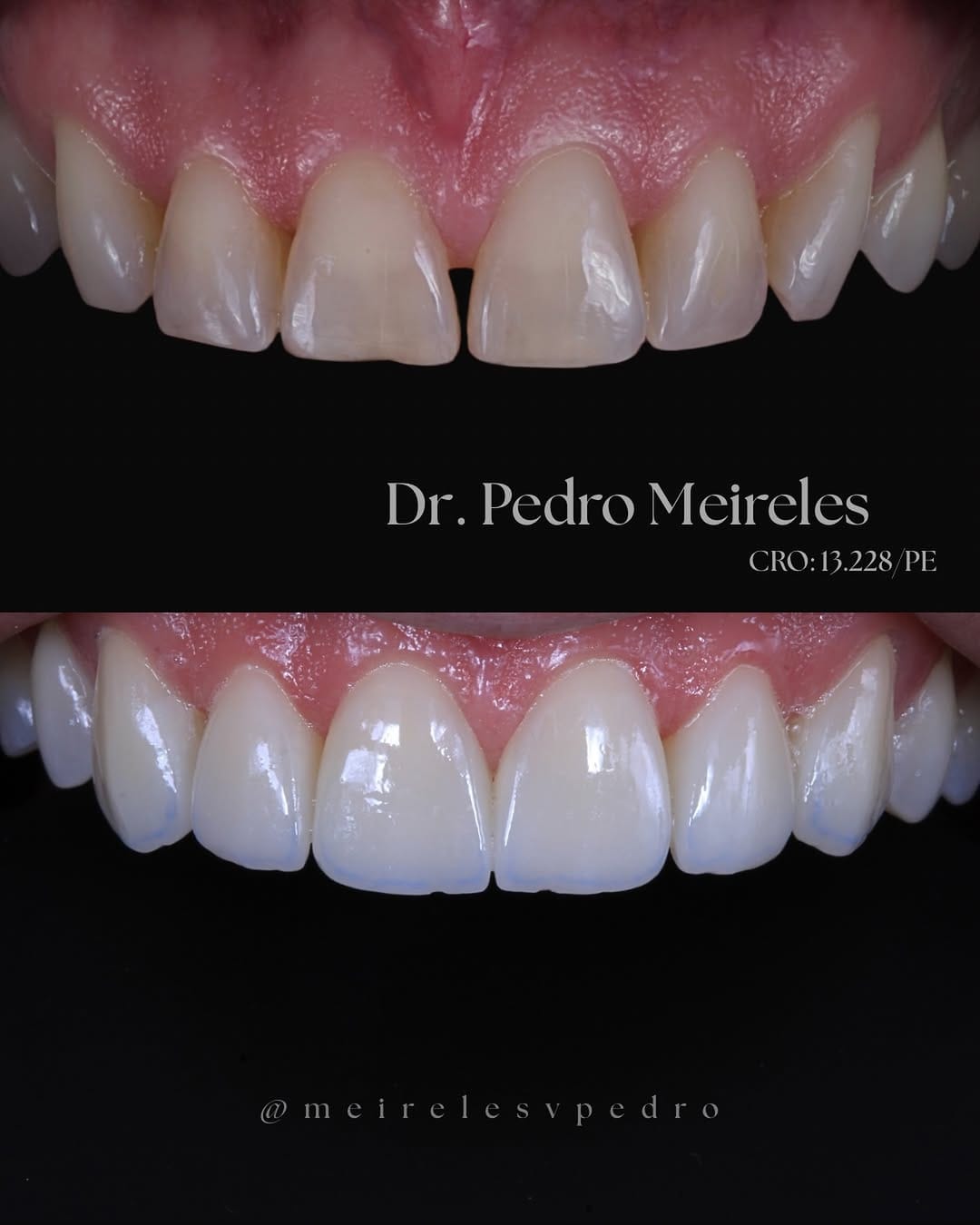 Post 2 by Pedro Meireles || Facetas e Lentes de contato on Instagram (image)