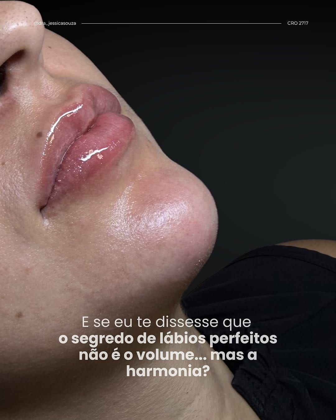 Post 6 by Jéssica Souza/ Harmonização Facial/ Lipopapada Avançada on Instagram (carousel)