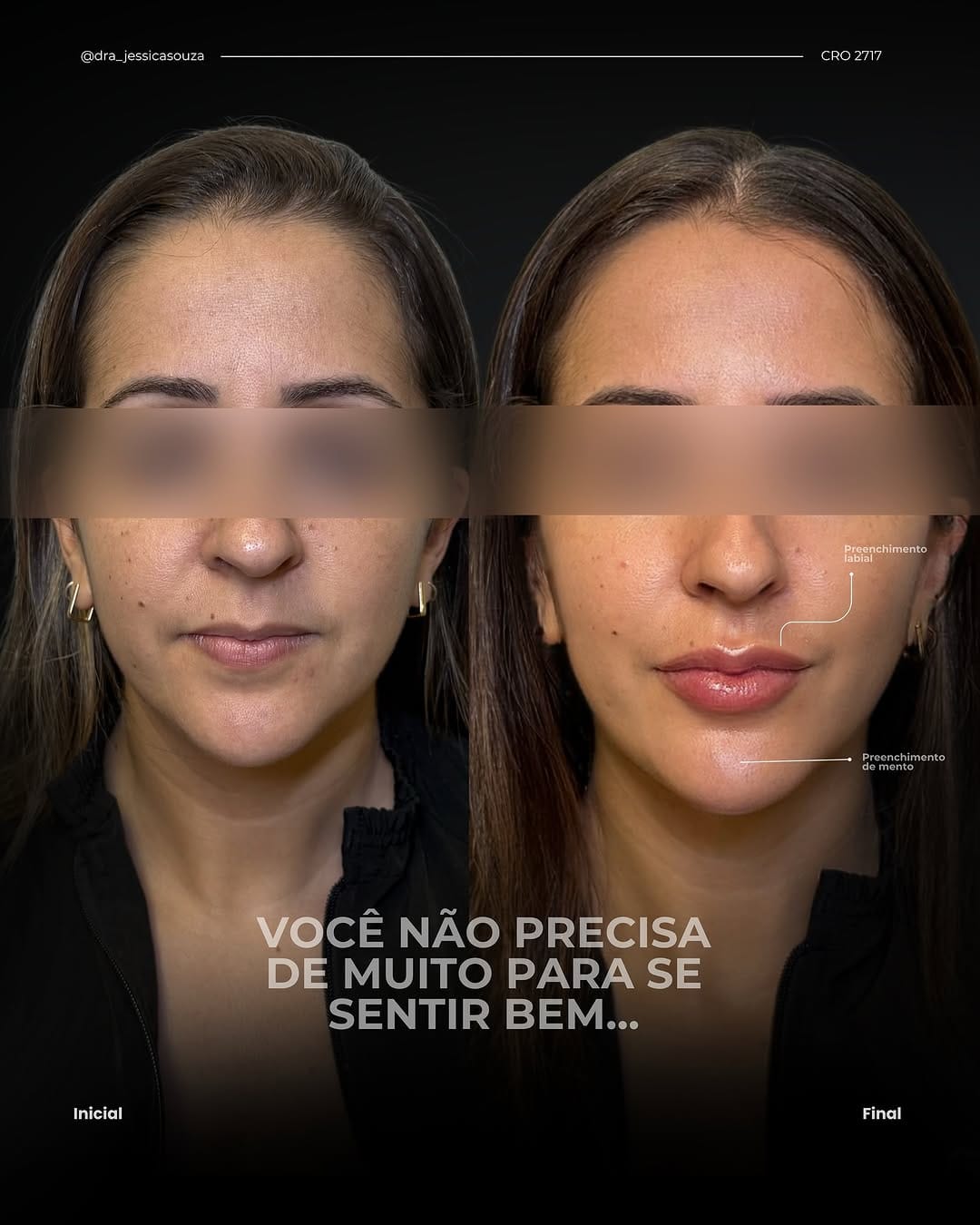 Post 7 by Jéssica Souza/ Harmonização Facial/ Lipopapada Avançada on Instagram (carousel)
