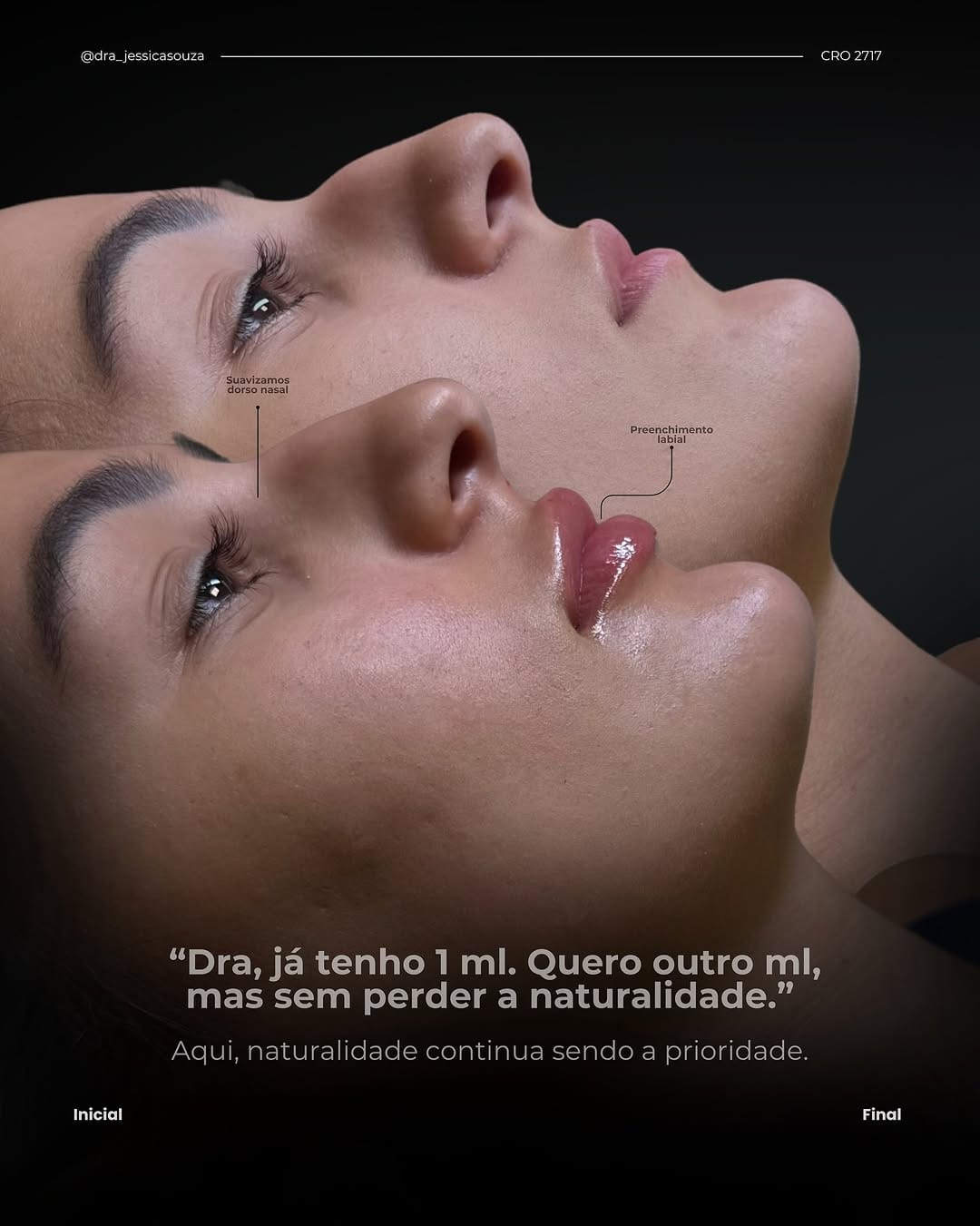 Post 3 by Jéssica Souza/ Harmonização Facial/ Lipopapada Avançada on Instagram (carousel)