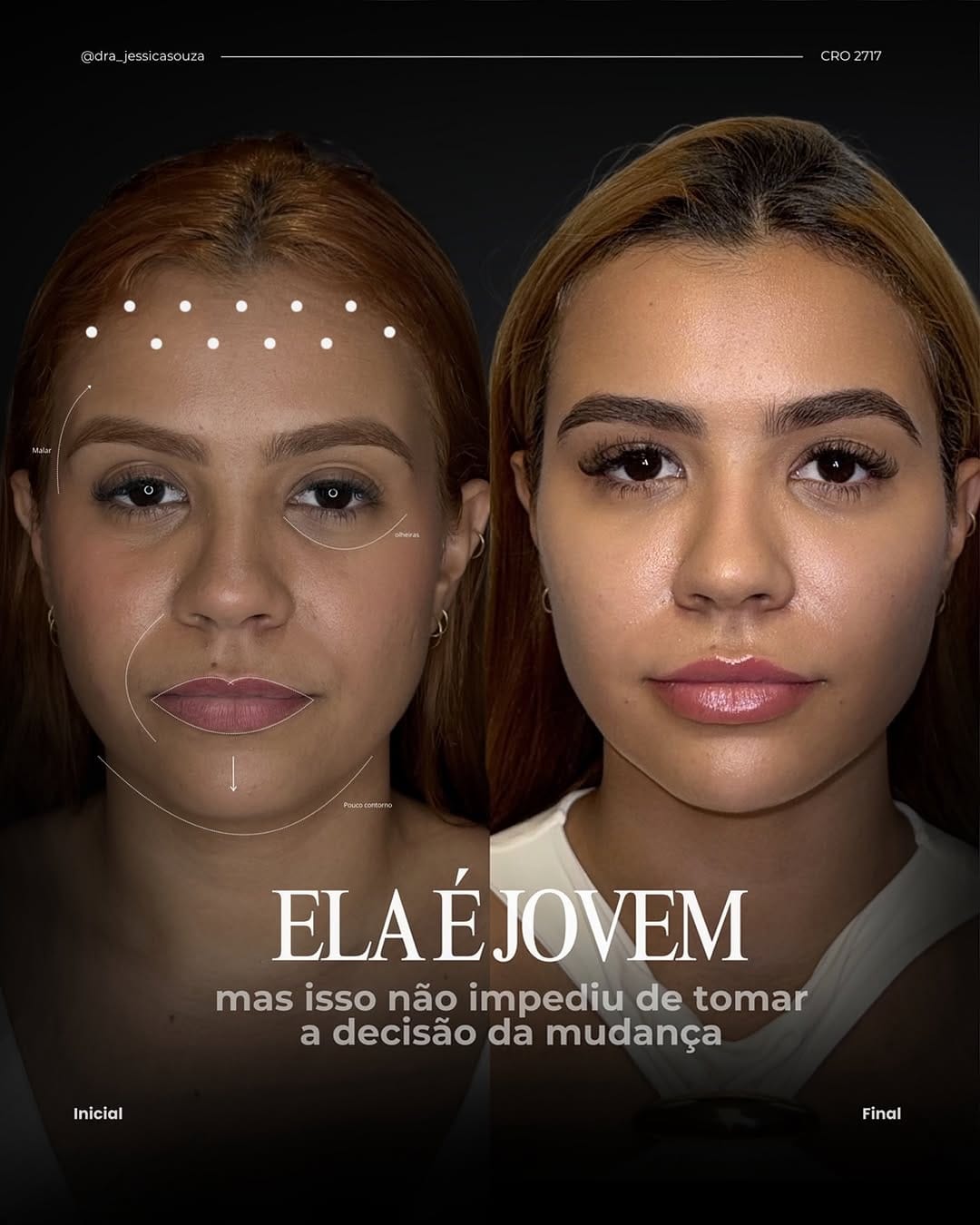 Post 5 by Jéssica Souza/ Harmonização Facial/ Lipopapada Avançada on Instagram (carousel)