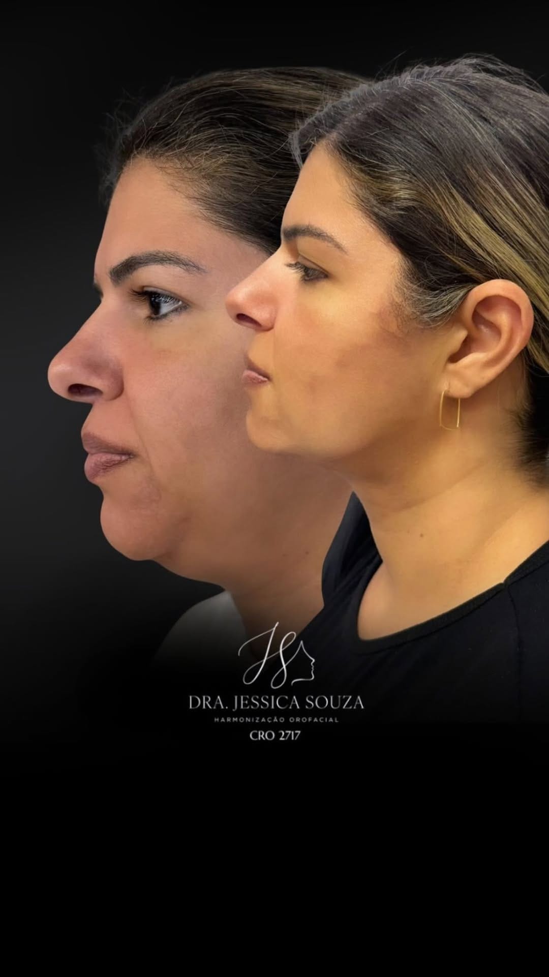 Post 9 by Jéssica Souza/ Harmonização Facial/ Lipopapada Avançada on Instagram (video)
