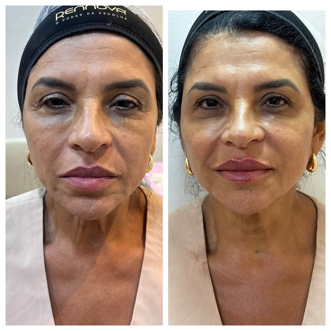 Post 10 by Fabiana Gonçalves | Harmonização Facial Lauro de Freitas on Instagram (carousel)