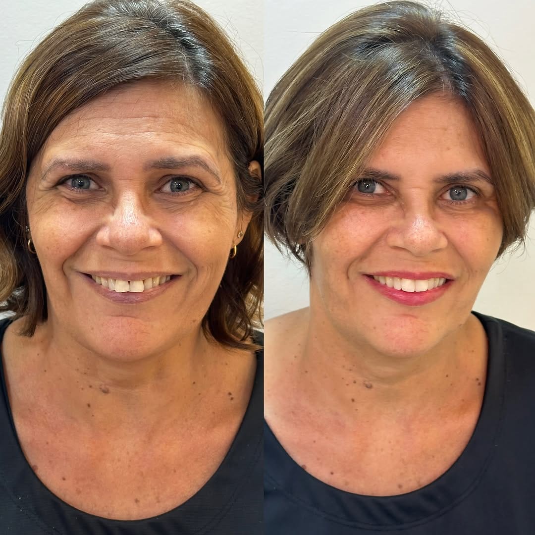 Post 9 by Fabiana Gonçalves | Harmonização Facial Lauro de Freitas on Instagram (carousel)
