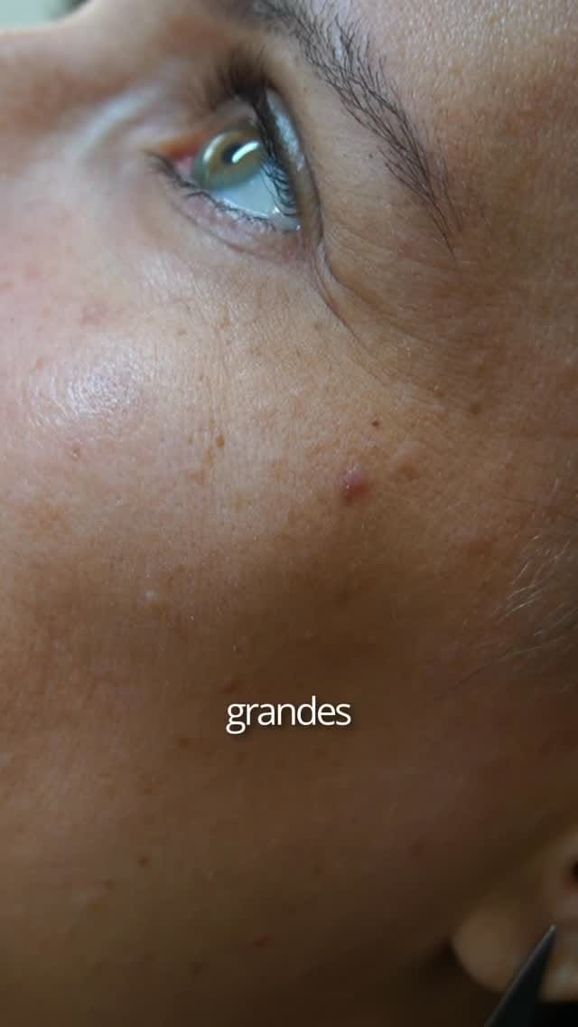 Post 1 by Dr. Gustavo Ávila | Dermatologista | Câncer de Pele on Instagram (video)