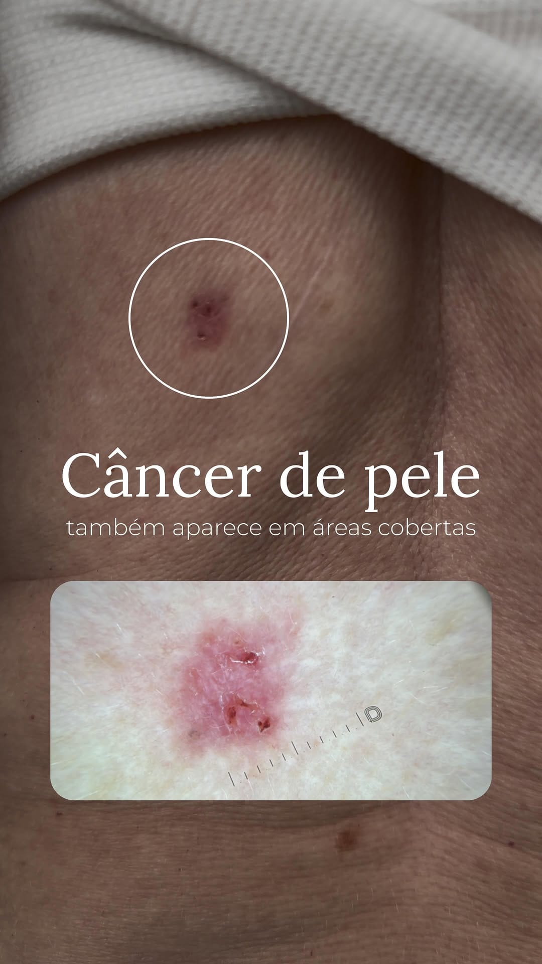 Post 10 by Dr. Gustavo Ávila | Dermatologista | Câncer de Pele on Instagram (video)