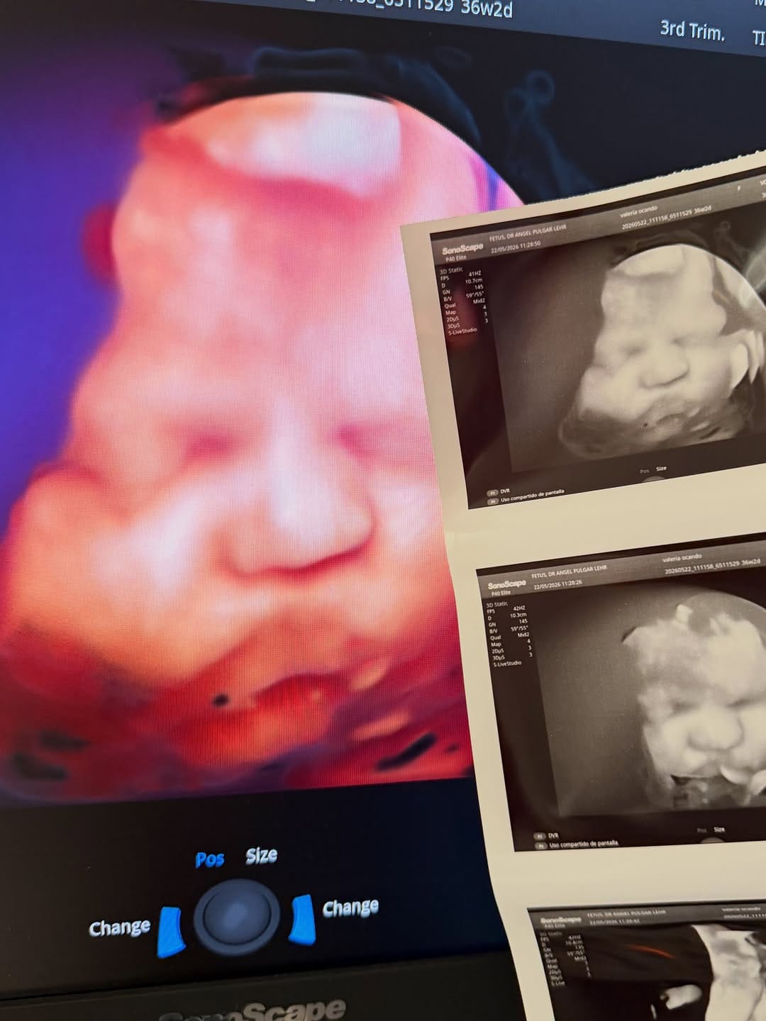 Post 2 by Dr. Angel Pulgar Lehr | Especialista en Salud Materno Fetal on Instagram (carousel)