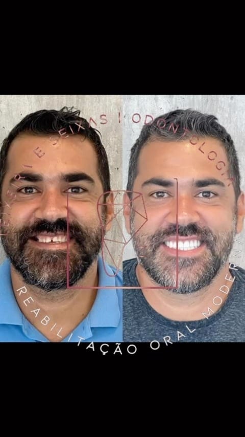 Post 9 by DR. JOÃO SEIXAS | DENTISTA | IMPLANTES on Instagram (video)