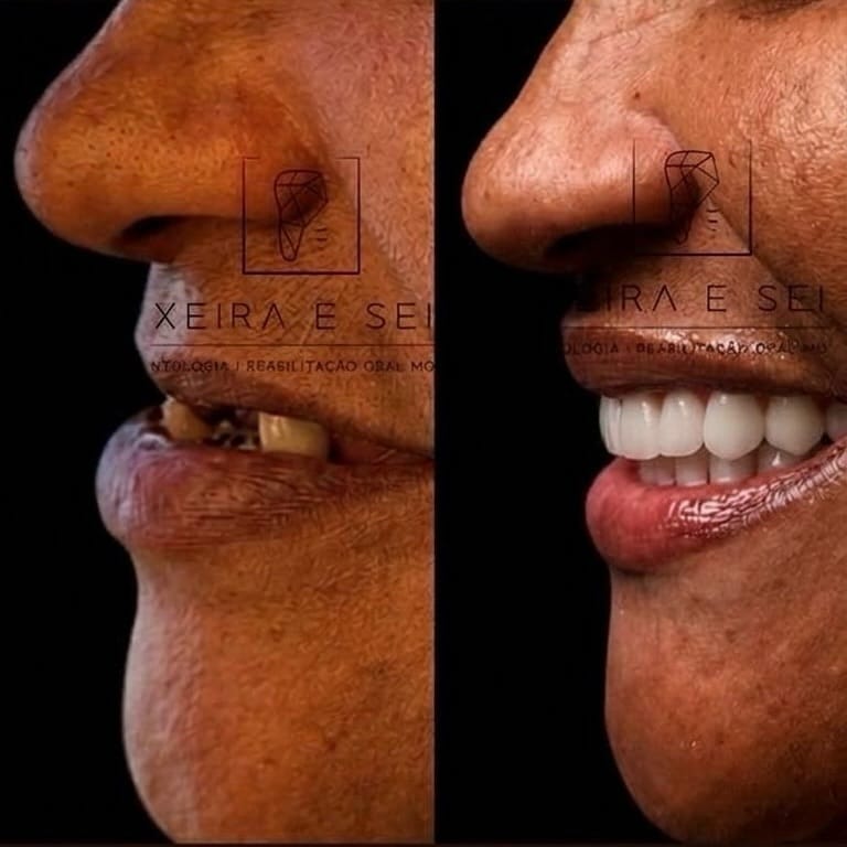 Post 3 by DR. JOÃO SEIXAS | DENTISTA | IMPLANTES on Instagram (image)