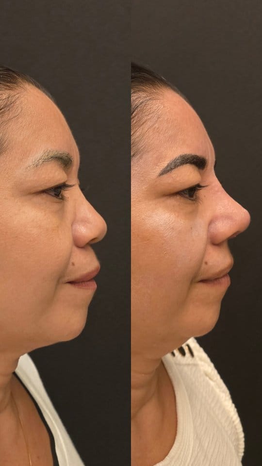 Post 3 by Dr. Paulo Igor - Rinoplastia on Instagram (video)
