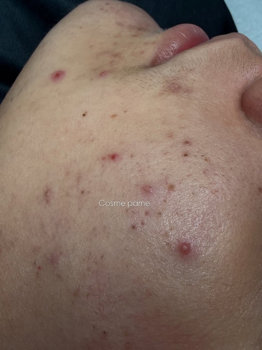 Post 8 by Clínica  de Cosmetología y Cosmiatria Corporal Pamela Rojas on Instagram (carousel)