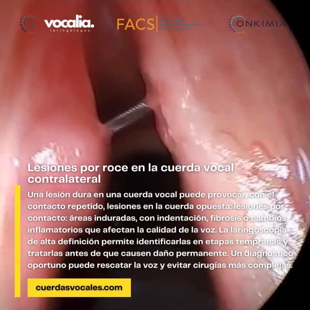 Post 6 by Dr. Gerardo López Guerra | Laringología y Trastornos de la Voz on Instagram (video)