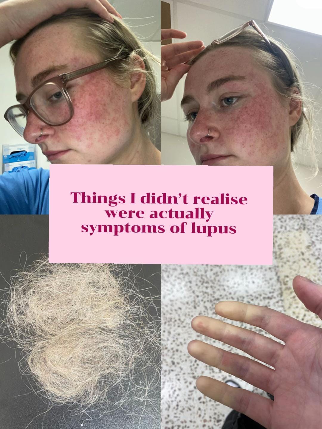 Post 10 by Jess MyLupusUnfiltered💜🦋 on TikTok (video)