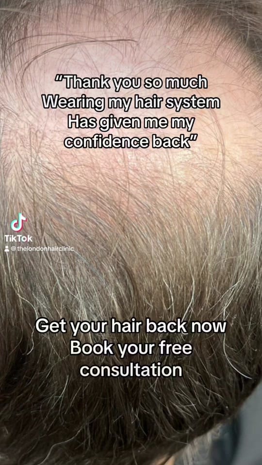 Post 8 by TheLondonHairClinic on TikTok (video)