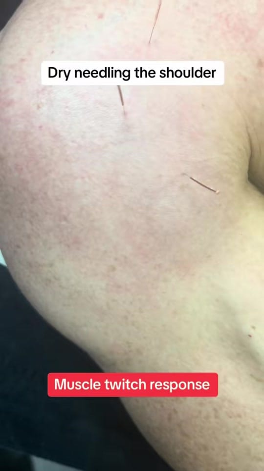 Post 1 by 5Physio on TikTok (video)