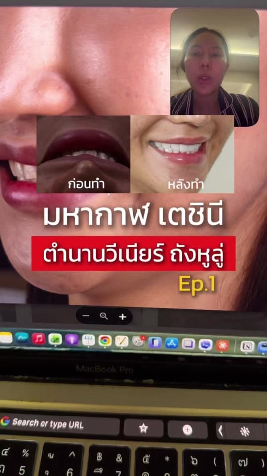 Post 1 by หมอป่องสวยมาก veneer 🦷 on TikTok (video)