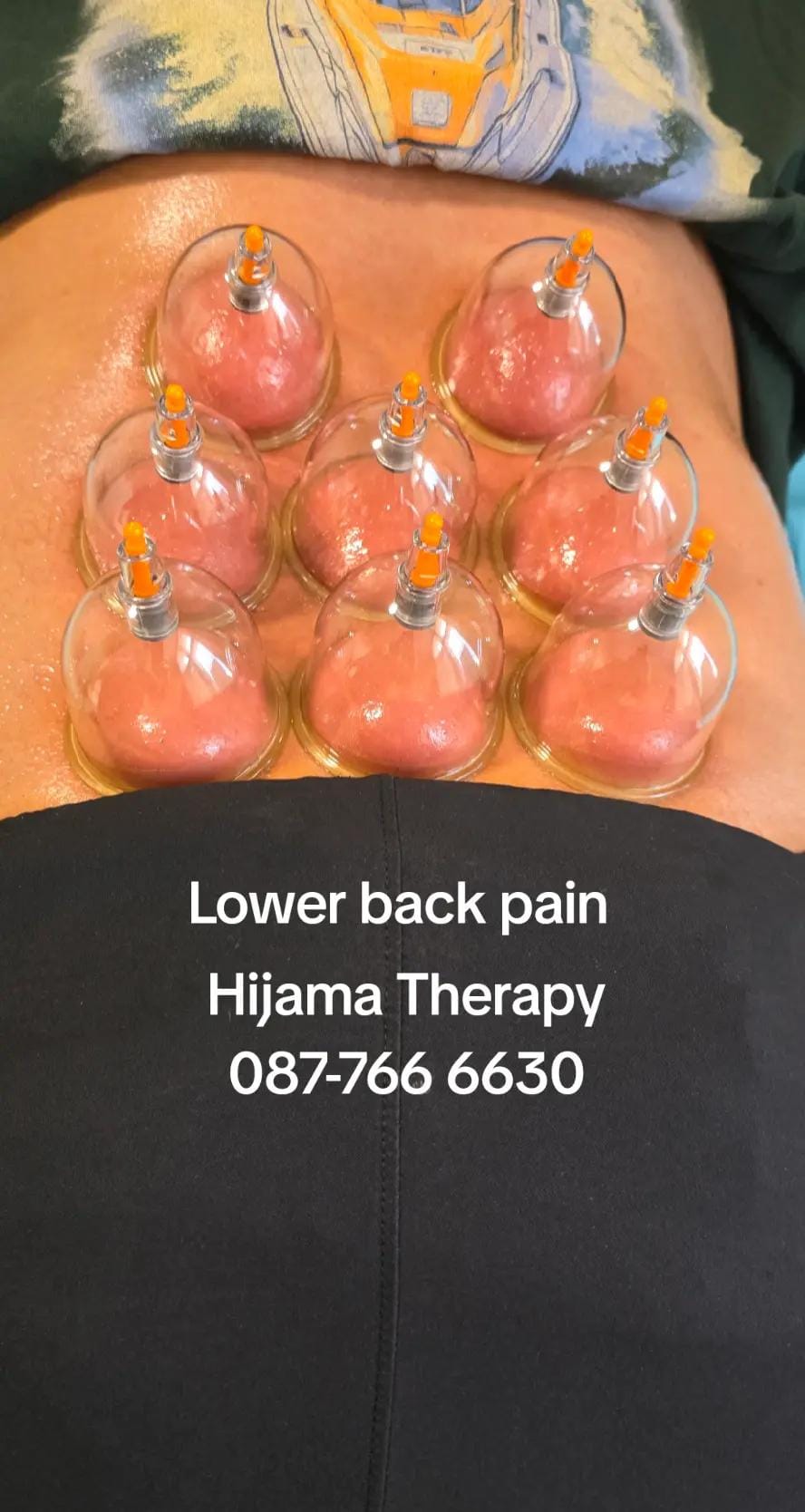 Post 6 by Hijama Therapy 🇮🇪 on TikTok (video)