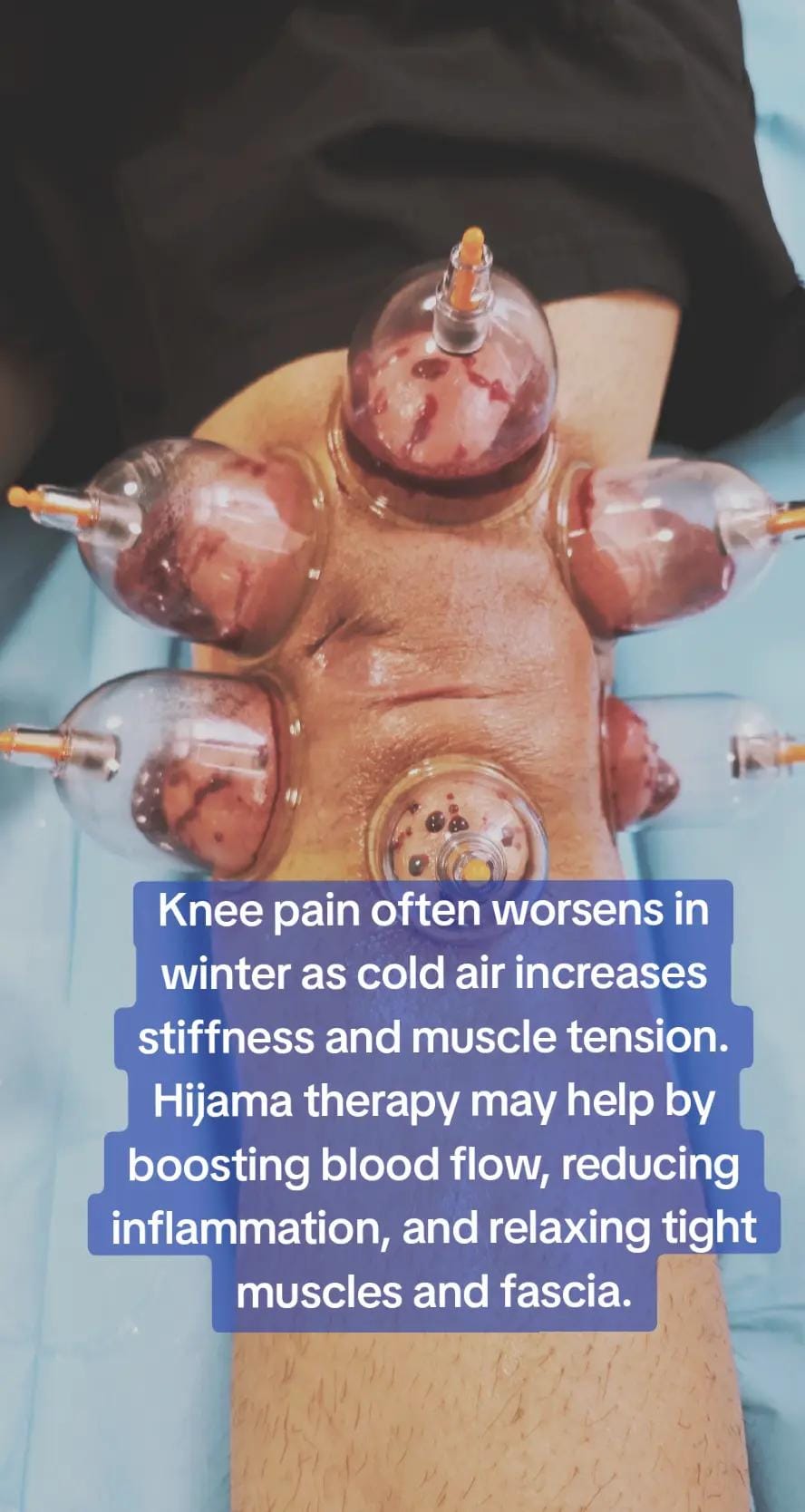 Post 4 by Hijama Therapy 🇮🇪 on TikTok (video)