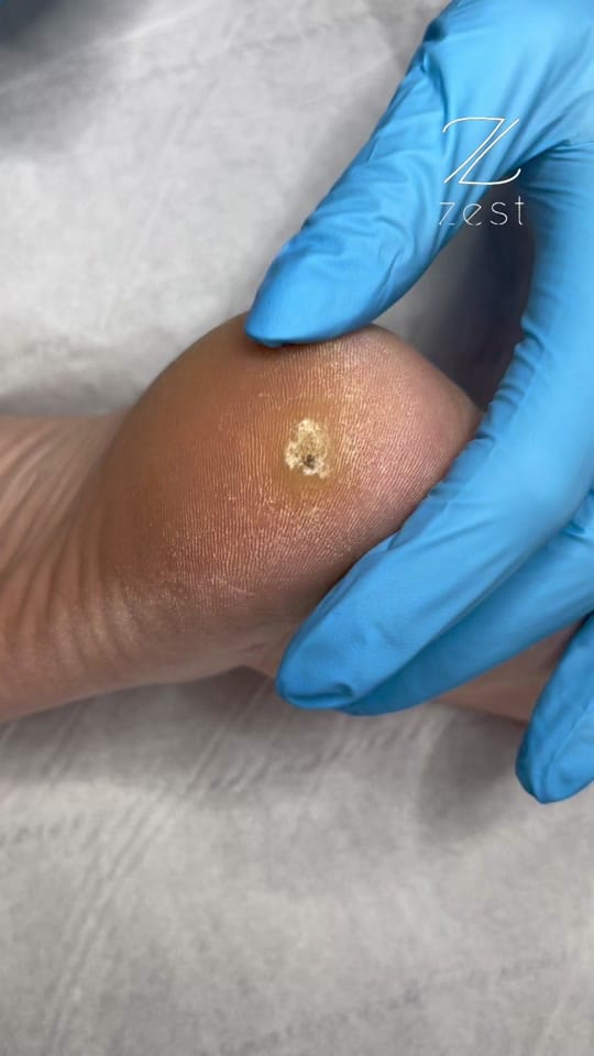 Post 10 by Zest Podiatry on TikTok (video)