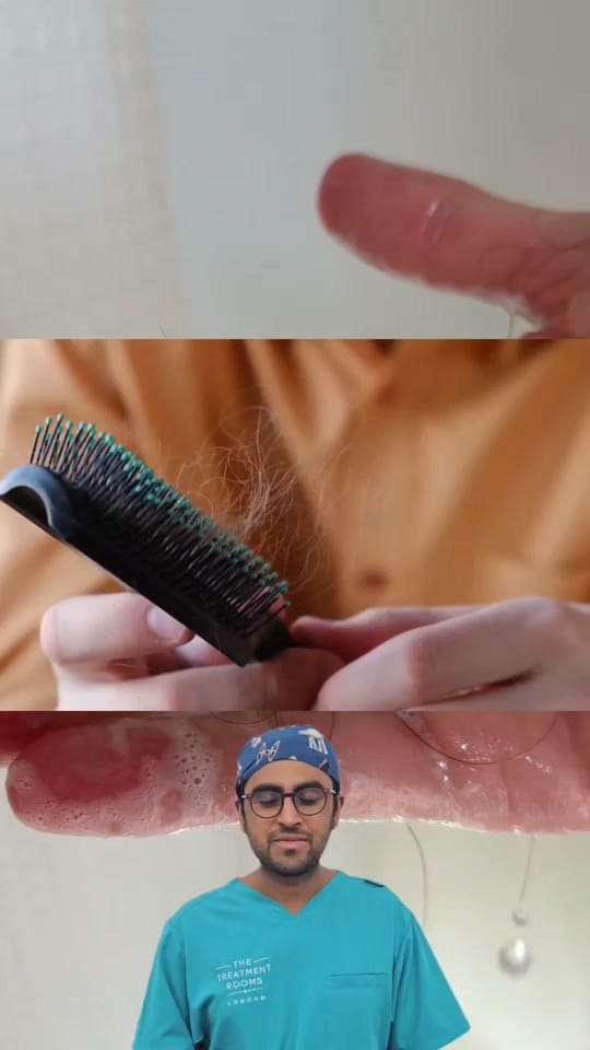 Post 1 by Hair Transplant Clinic on TikTok (video)