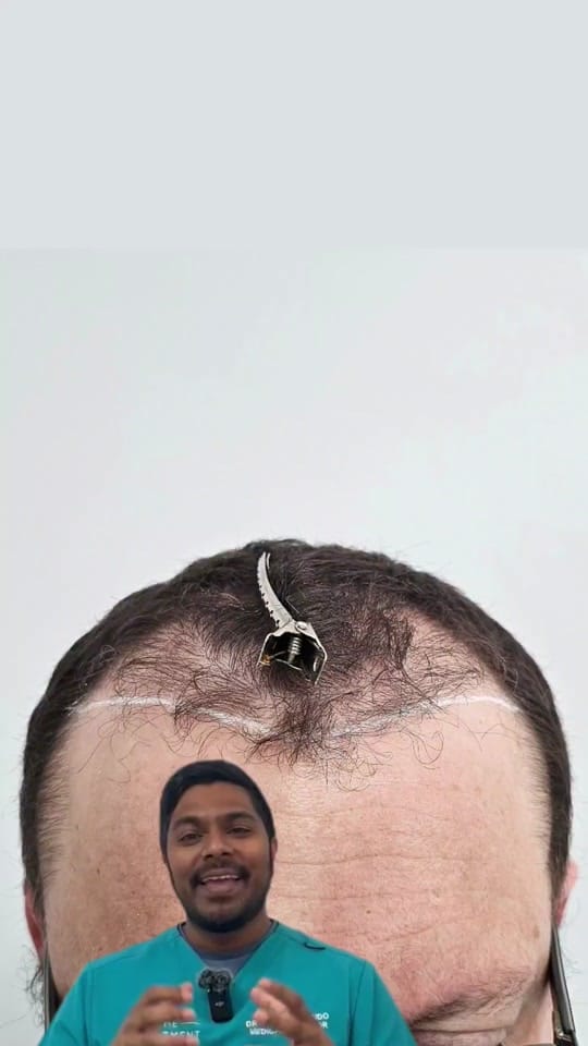 Post 2 by Hair Transplant Clinic on TikTok (video)