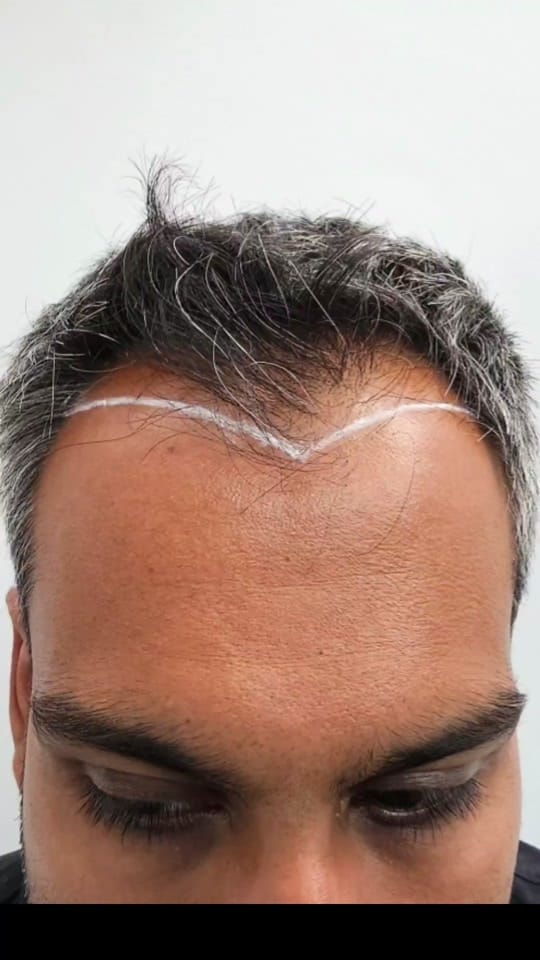Post 8 by Hair Transplant Clinic on TikTok (video)