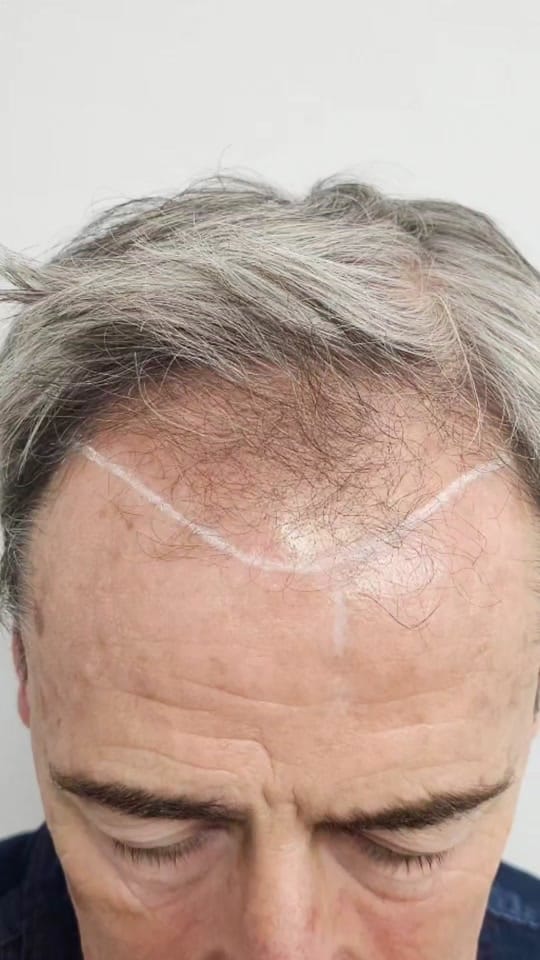 Post 10 by Hair Transplant Clinic on TikTok (video)