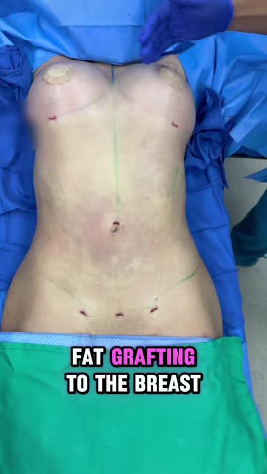 Post 4 by Chicago Breast&Body Aesthetics on TikTok (video)