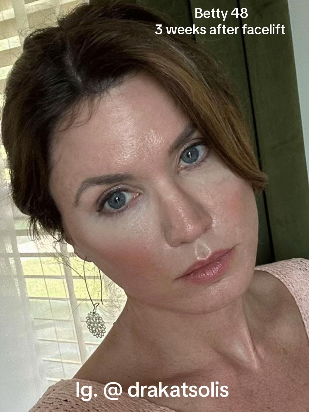 Post 1 by Dra Kat Solís / Facial surgery on TikTok (video)