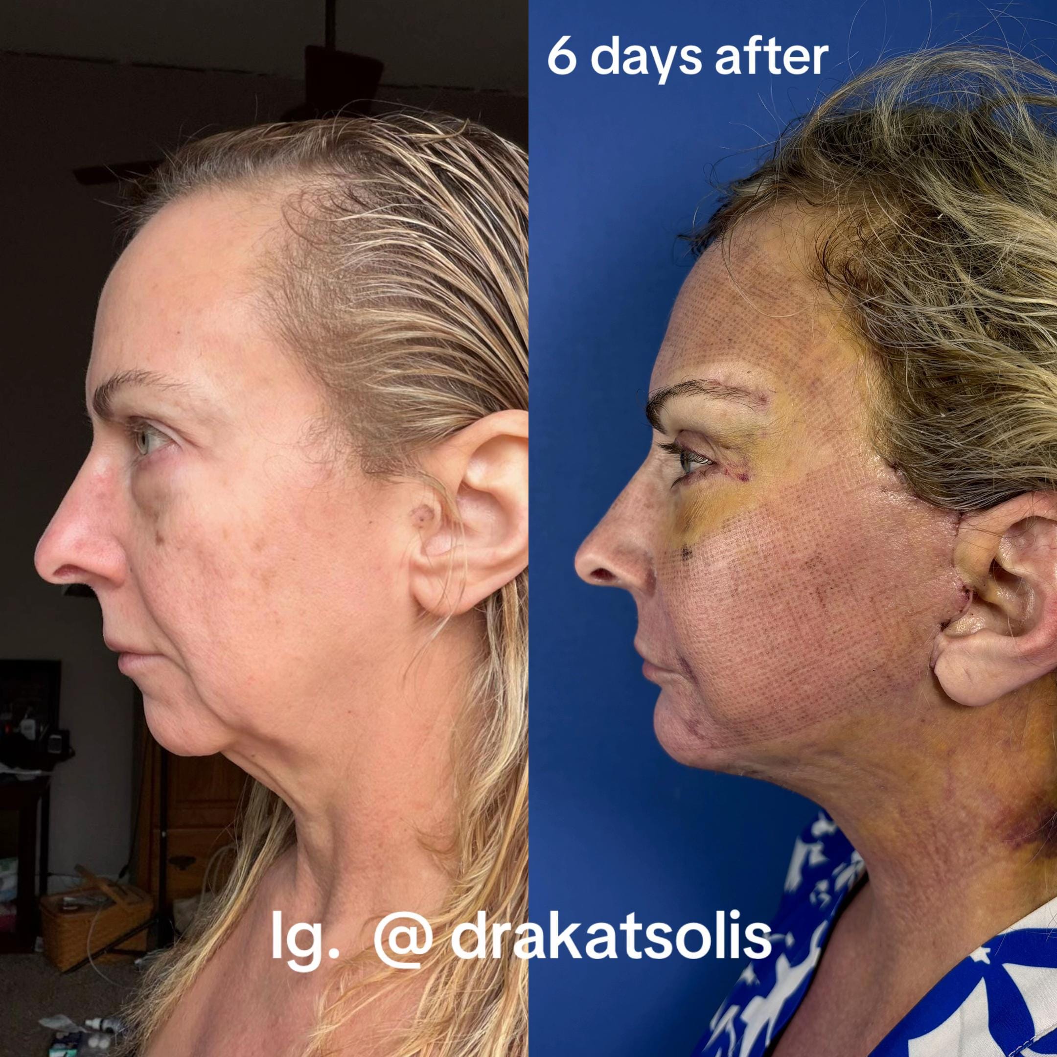 Post 3 by Dra Kat Solís / Facial surgery on TikTok (video)