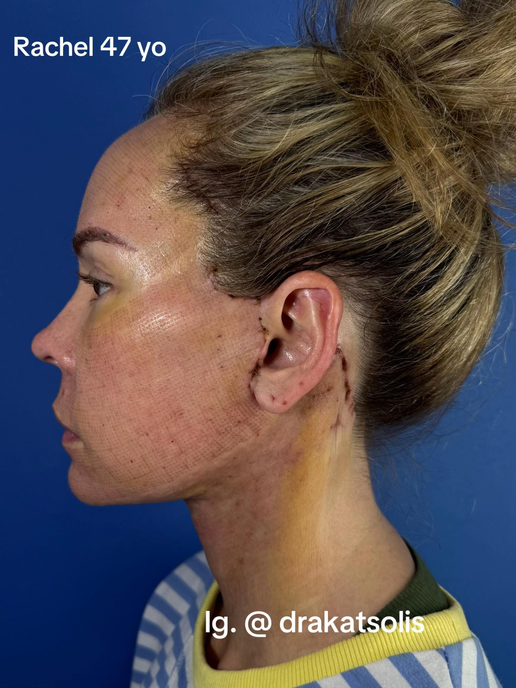 Post 4 by Dra Kat Solís / Facial surgery on TikTok (video)