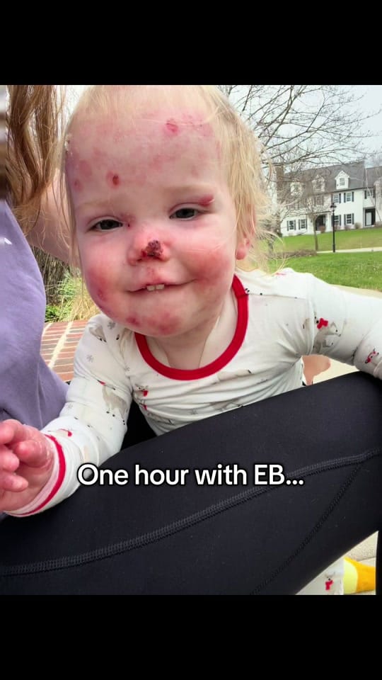 Post 2 by Mackenzie’s EB Journey 🦋 on TikTok (video)
