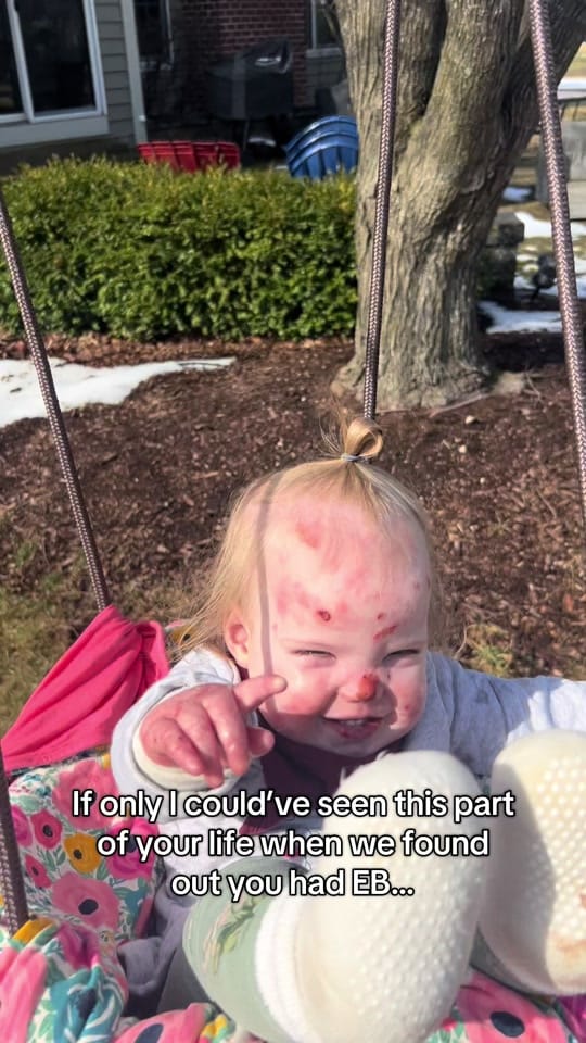 Post 9 by Mackenzie’s EB Journey 🦋 on TikTok (video)