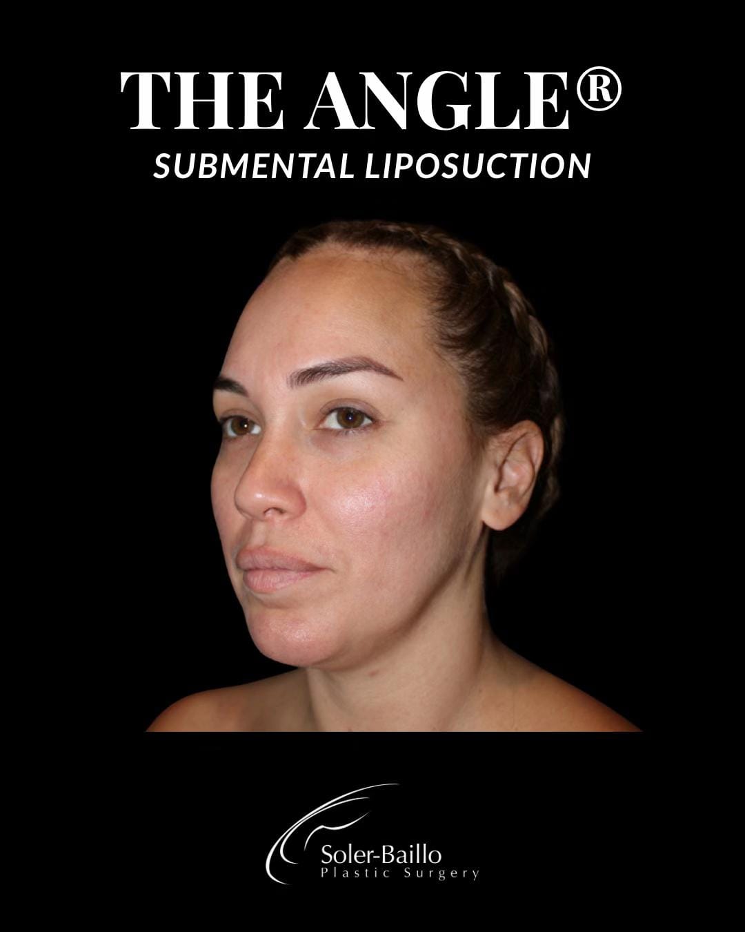 Post 8 by Soler Baillo Plastic Surgery on TikTok (video)