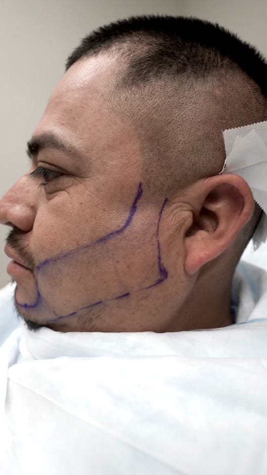 Post 10 by Hair Transplant Miami on TikTok (video)
