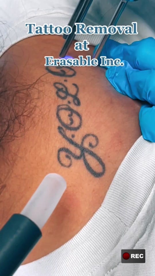 Post 10 by erasablemedspa on TikTok (video)