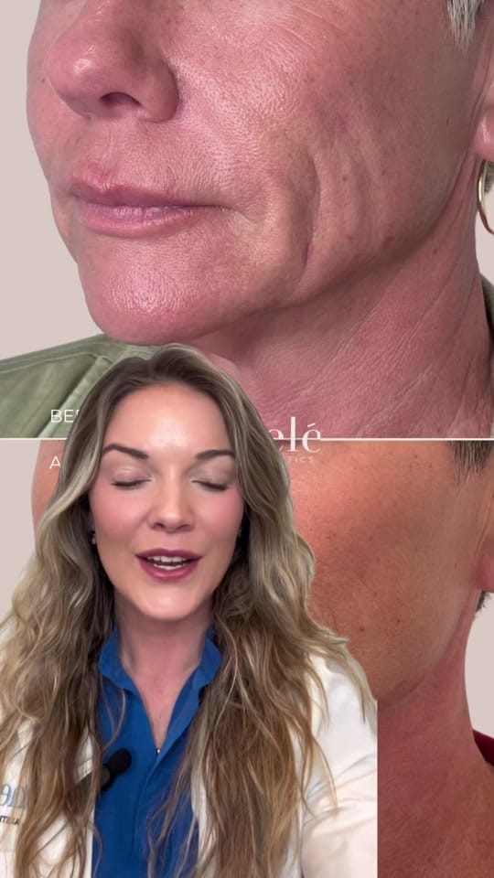 Post 5 by lachelemedspa on TikTok (video)