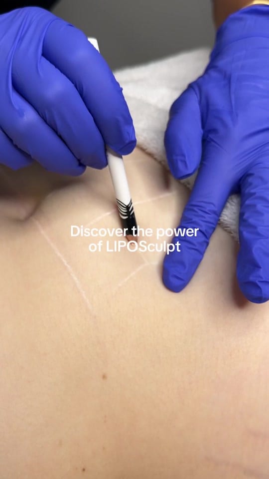 Post 8 by BODY SCULPTING CLINICS™ on TikTok (video)