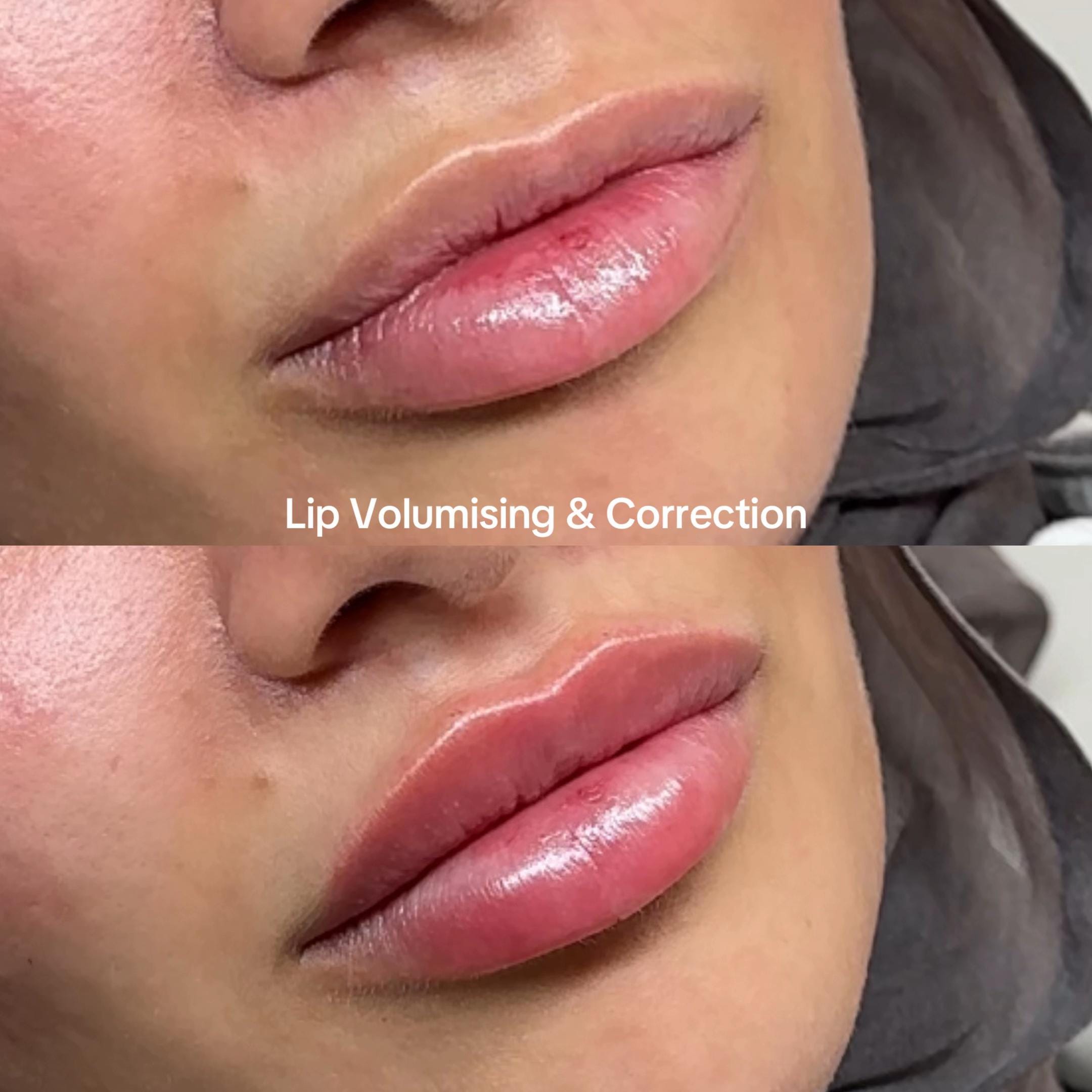Post 1 by RN SABRINA | COSMETIC NURSE on TikTok (video)