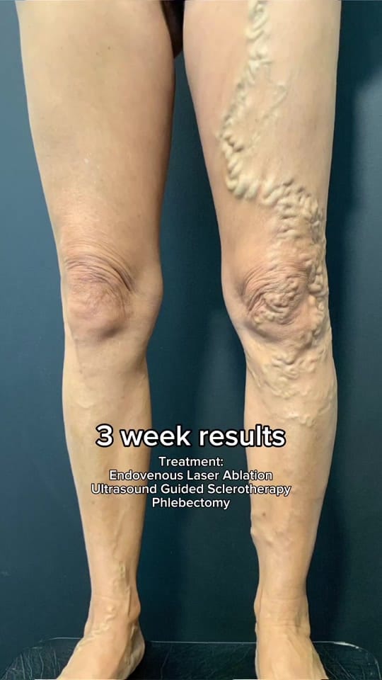 Post 10 by The Varicose Vein Clinic on TikTok (video)