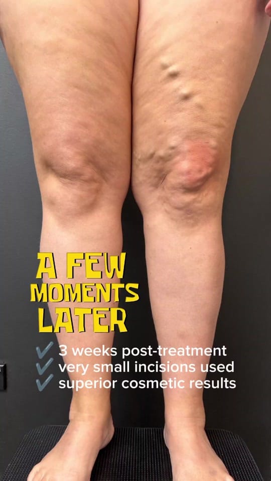 Post 3 by The Varicose Vein Clinic on TikTok (video)